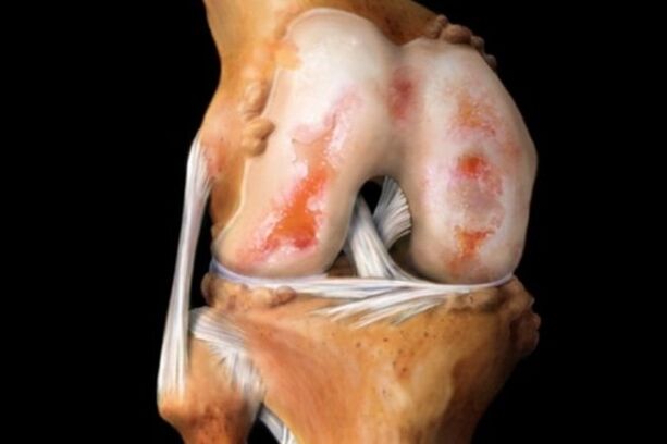Destruction of the knee joint due to arthrosis - a general pathology of the musculoskeletal system