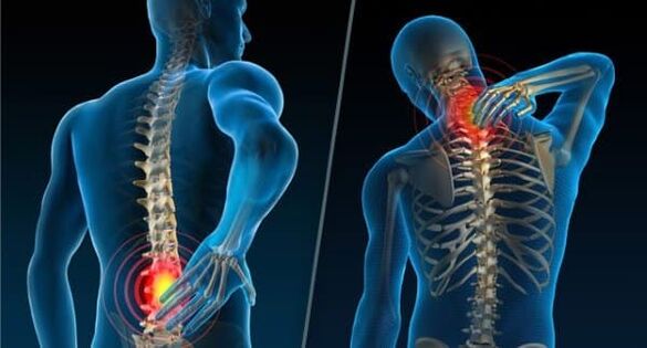 Signs of the development of osteochondrosis - pain in the neck and back