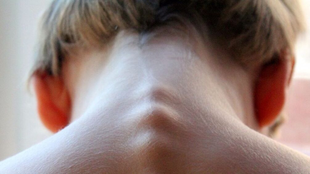 spines