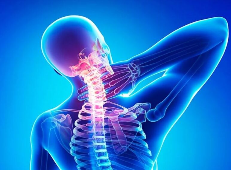 Osteocondrosis of cervical waist