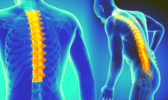 Osteocondrosis of the spine