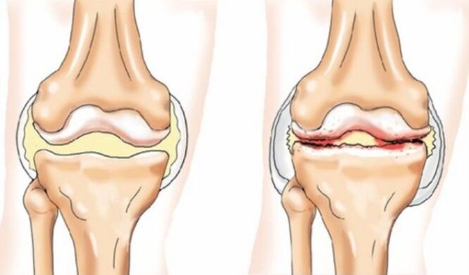 Differences in arthritis and artrosis