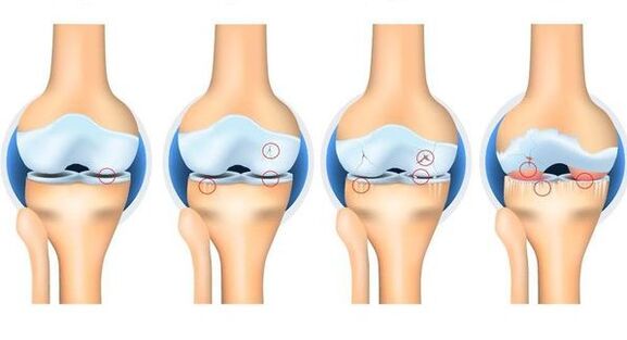 Stages of osteortrosis