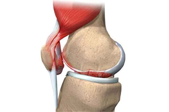 Aggravation of arthrosis