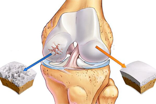 What is Arthroz