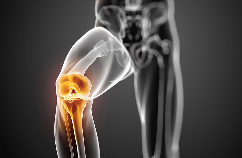 Artrosis of knee joint