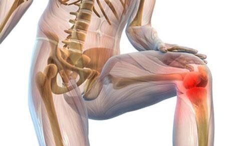 Artrosis of knee joint