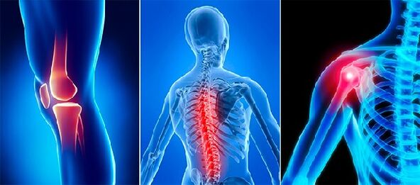 Joint pain in Arthose