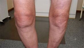 Symptoms of arthrosis