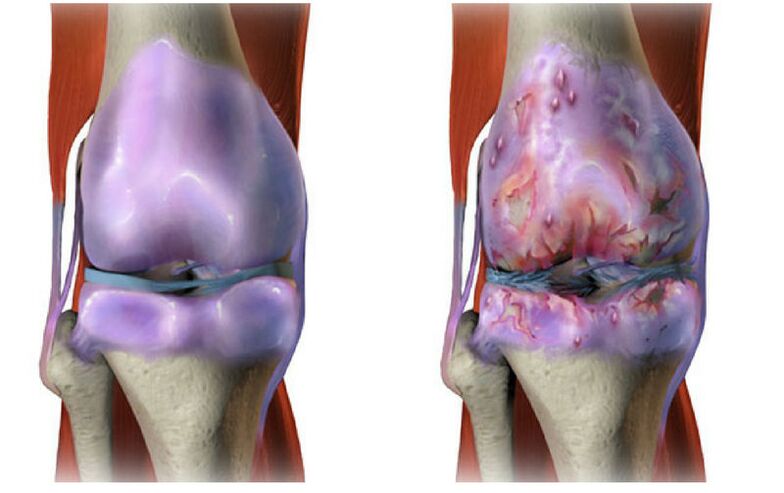 destruction of healthy cartilage and knee joint with arthrosis