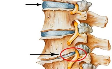 developmental stages of cervical osteochondrosis