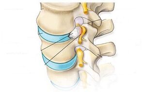 main symptoms of cervical osteochondrosis