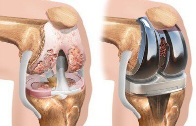 Endoprosthesis of the knee joint with gonarthrosis